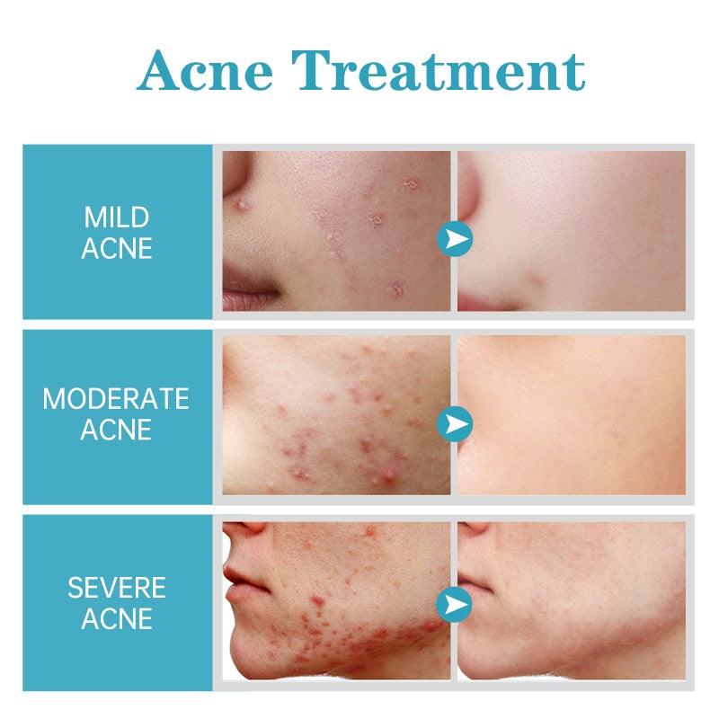 Creme AclaraClear - Tratamento de acnes, cicatrizes e manchas faciais de espinhas BRILHO E ENCANTO